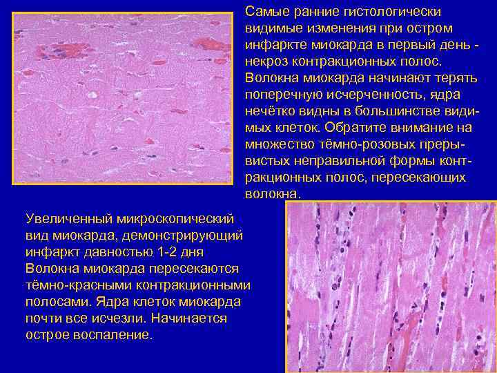 Самые ранние гистологически видимые изменения при остром инфаркте миокарда в первый день некроз контракционных