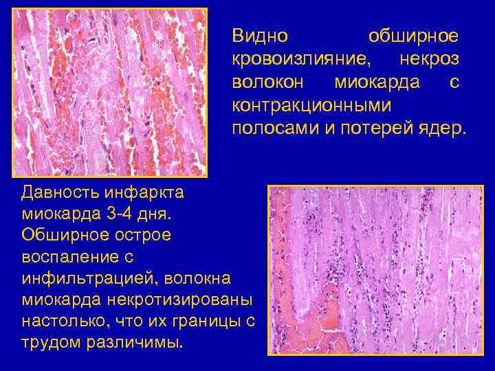 Видно обширное кровоизлияние, некроз волокон миокарда с контракционными полосами и потерей ядер. Давность инфаркта
