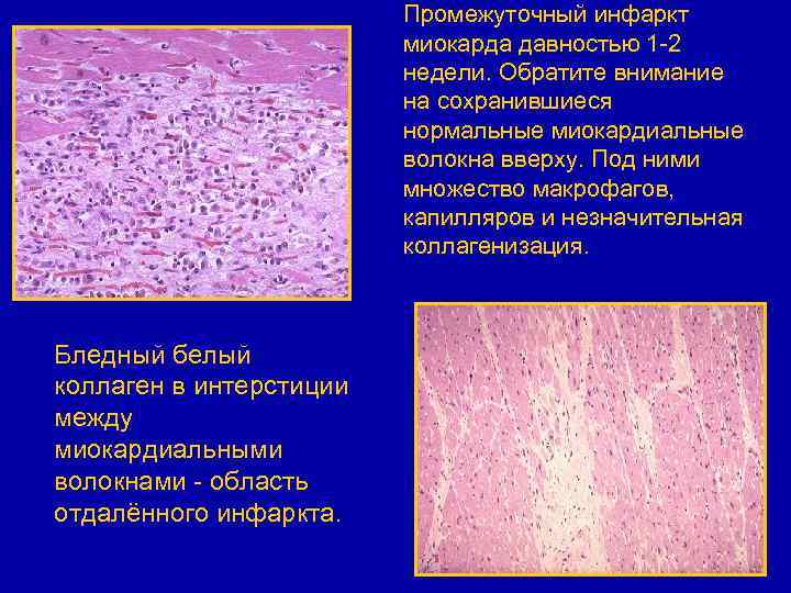 Промежуточный инфаркт миокарда давностью 1 -2 недели. Обратите внимание на сохранившиеся нормальные миокардиальные волокна