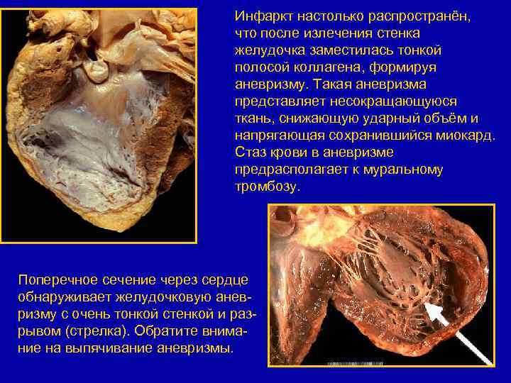 Инфаркт настолько распространён, что после излечения стенка желудочка заместилась тонкой полосой коллагена, формируя аневризму.