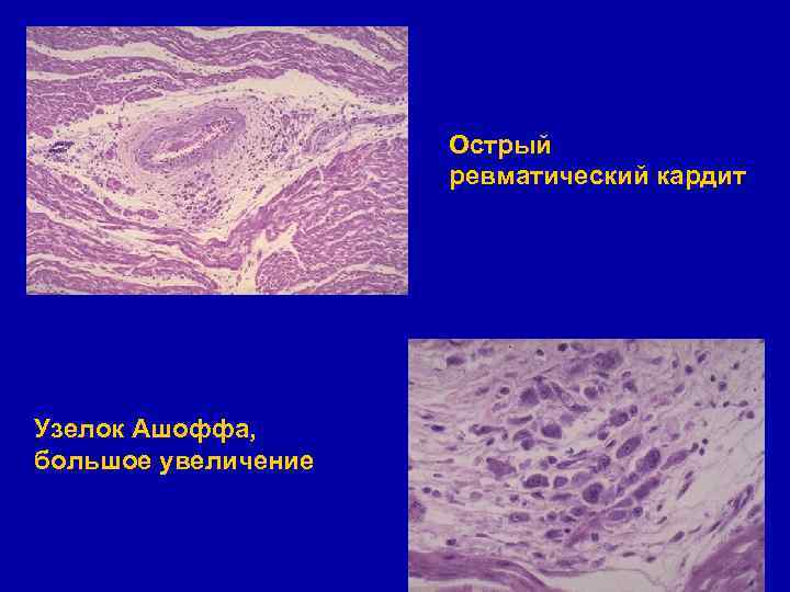 Острый ревматический кардит Узелок Ашоффа, большое увеличение 