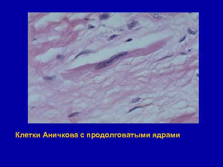 Клетки Аничкова с продолговатыми ядрами 