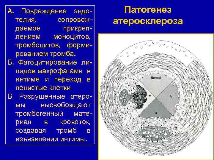 Повреждение эндотелия, сопровождаемое прикреплением моноцитов, тромбоцитов, формированием тромба. Б. Фагоцитирование липидов макрофагами в интиме