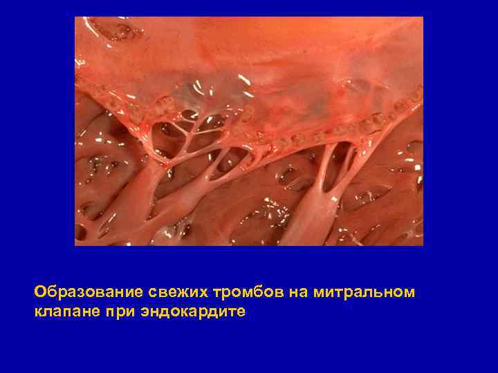 Образование свежих тромбов на митральном клапане при эндокардите 