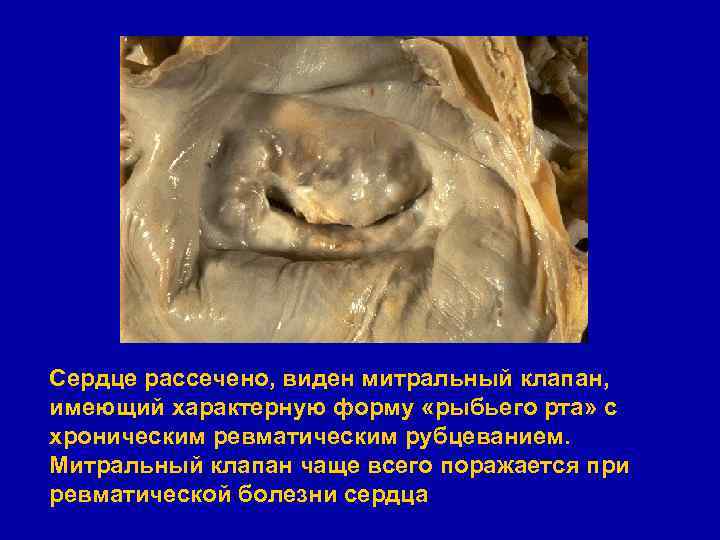 Сердце рассечено, виден митральный клапан, имеющий характерную форму «рыбьего рта» с хроническим ревматическим рубцеванием.