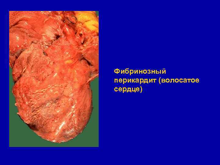 Фибринозный перикардит (волосатое сердце) 