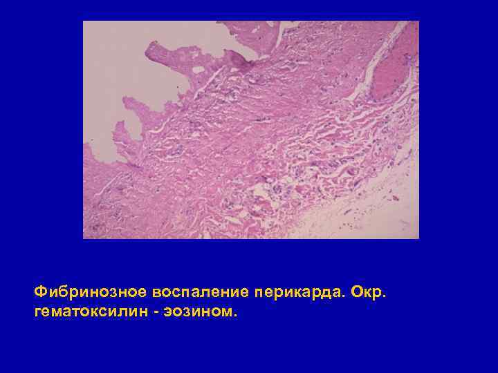 Фибринозное воспаление перикарда. Окр. гематоксилин - эозином. 