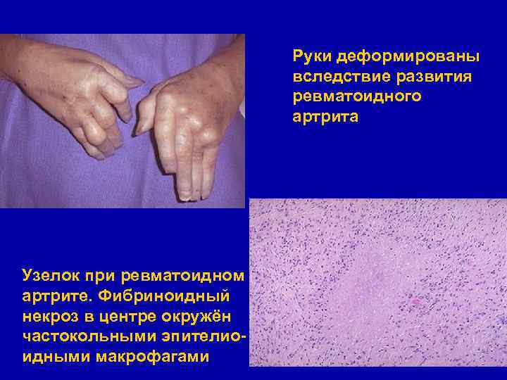 Руки деформированы вследствие развития ревматоидного артрита Узелок при ревматоидном артрите. Фибриноидный некроз в центре