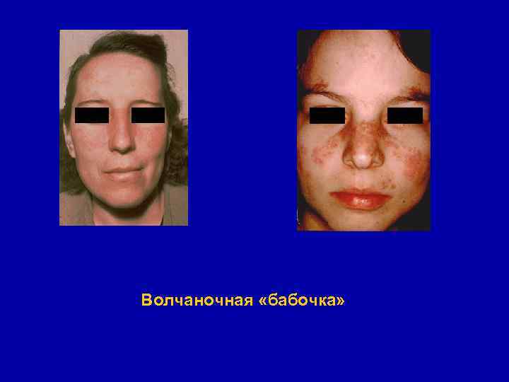 Волчаночная «бабочка» 