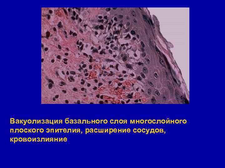 Вакуолизация базального слоя многослойного плоского эпителия, расширение сосудов, кровоизлияние 