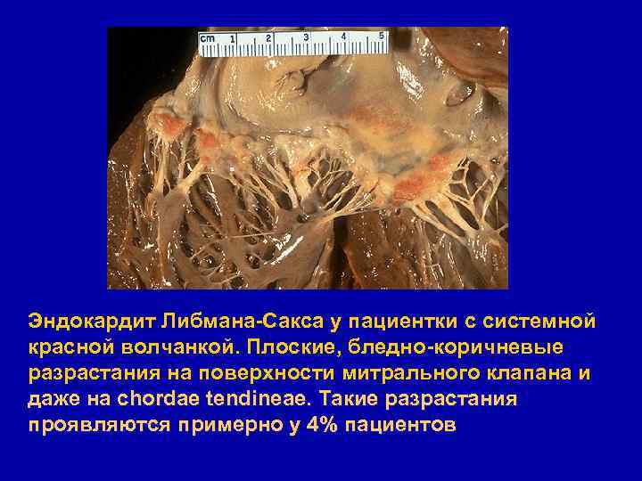 Эндокардит Либмана-Сакса у пациентки с системной красной волчанкой. Плоские, бледно-коричневые разрастания на поверхности митрального