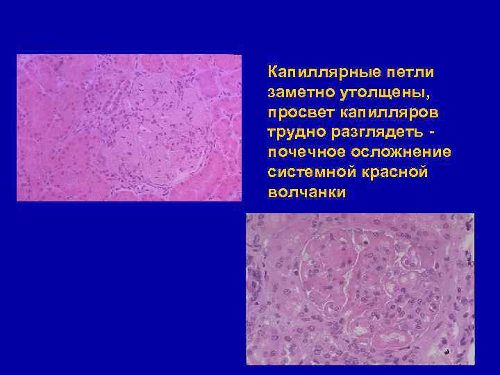 Капиллярные петли заметно утолщены, просвет капилляров трудно разглядеть почечное осложнение системной красной волчанки 