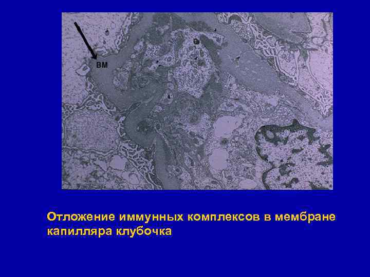 Отложение иммунных комплексов в мембране капилляра клубочка 