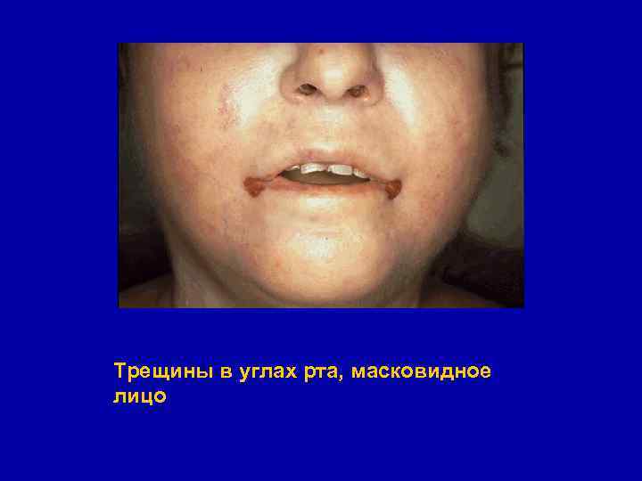 Трещины в углах рта, масковидное лицо 