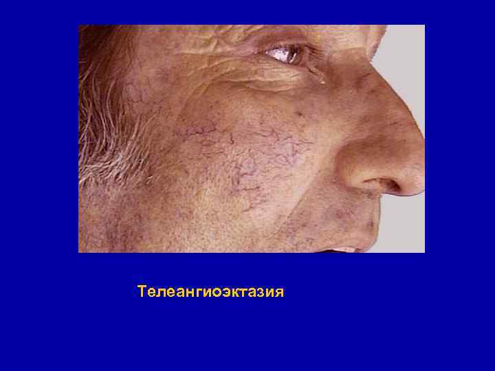 Телеангиоэктазия 