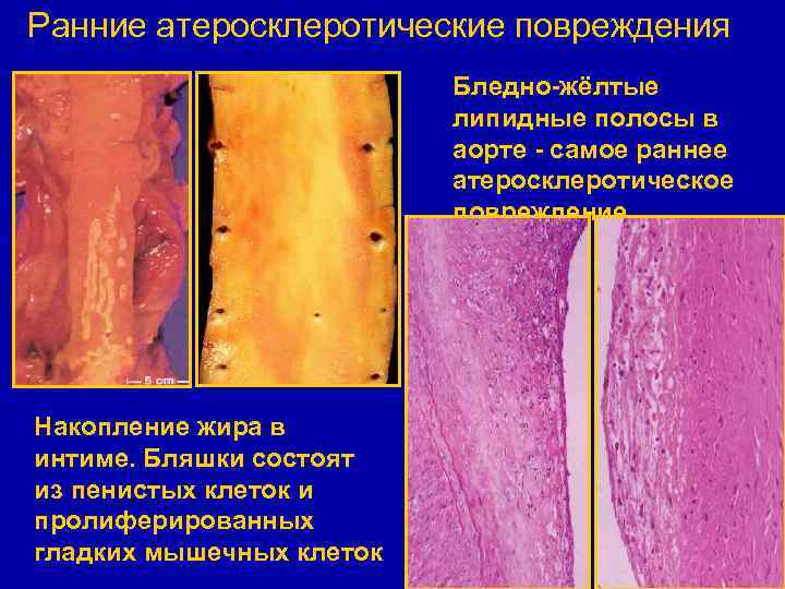 Ранние атеросклеротические повреждения Бледно-жёлтые липидные полосы в аорте - самое раннее атеросклеротическое повреждение. Накопление