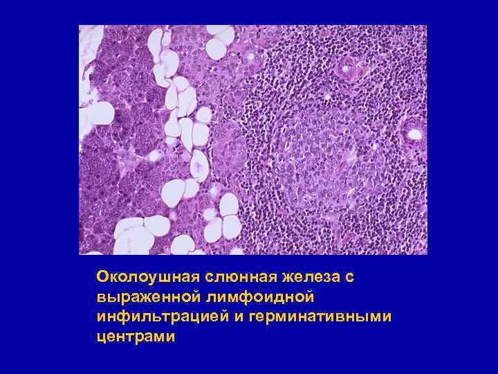 Околоушная слюнная железа с выраженной лимфоидной инфильтрацией и герминативными центрами 