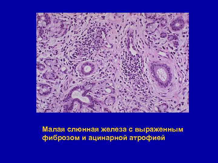 Малая слюнная железа с выраженным фиброзом и ацинарной атрофией 