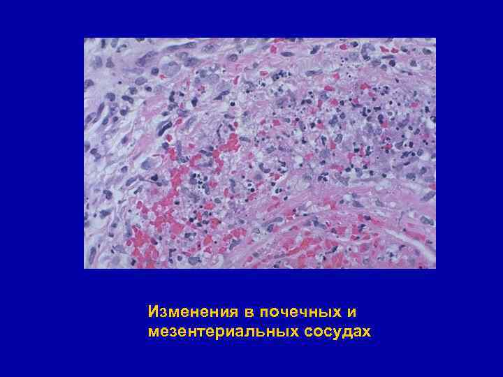 Изменения в почечных и мезентериальных сосудах 