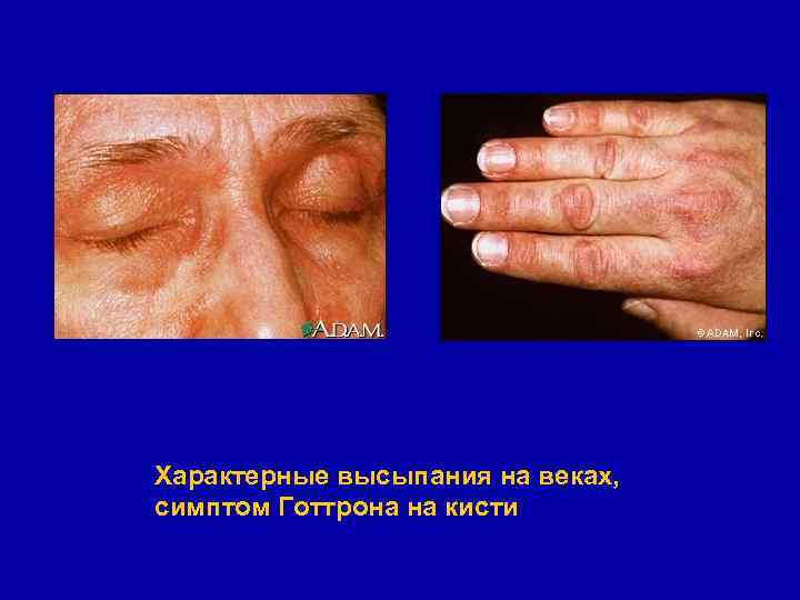 Характерные высыпания на веках, симптом Готтрона на кисти 