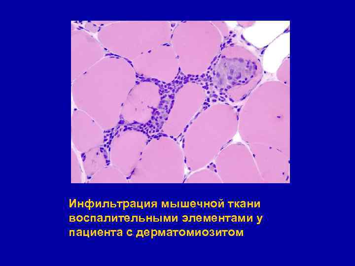 Инфильтрация мышечной ткани воспалительными элементами у пациента с дерматомиозитом 
