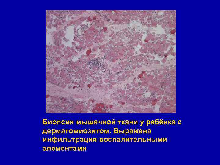 Биопсия мышечной ткани у ребёнка с дерматомиозитом. Выражена инфильтрация воспалительными элементами 