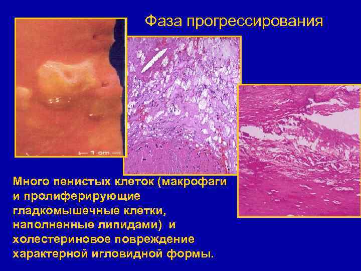 Фаза прогрессирования Много пенистых клеток (макрофаги и пролиферирующие гладкомышечные клетки, наполненные липидами) и холестериновое