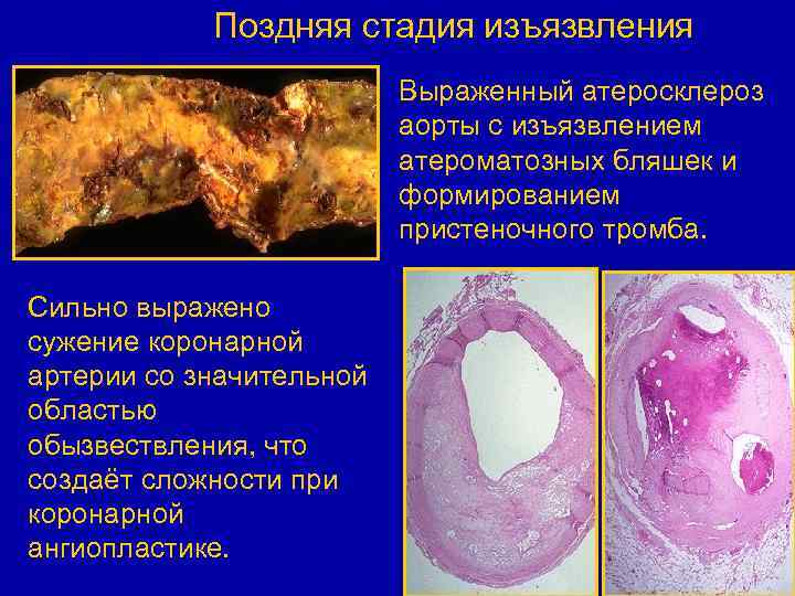 Поздняя стадия изъязвления Выраженный атеросклероз аорты с изъязвлением атероматозных бляшек и формированием пристеночного тромба.