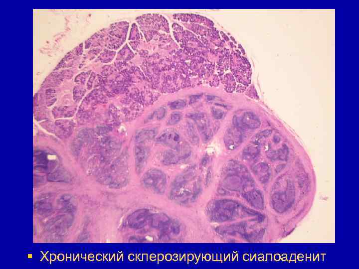 § Хронический склерозирующий сиалоаденит 