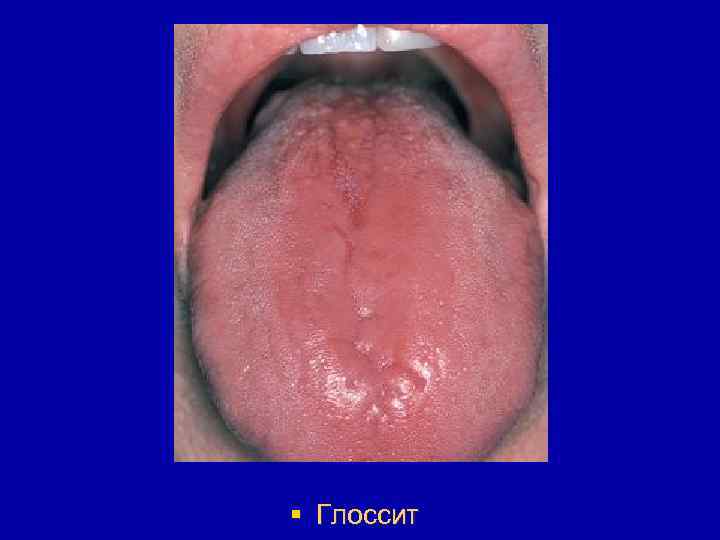 § Глоссит 