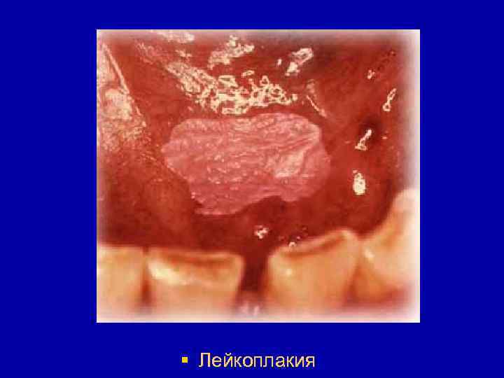§ Лейкоплакия 