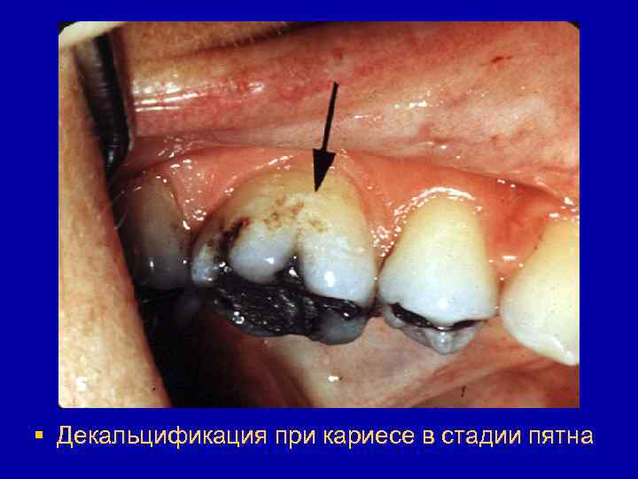 § Декальцификация при кариесе в стадии пятна 