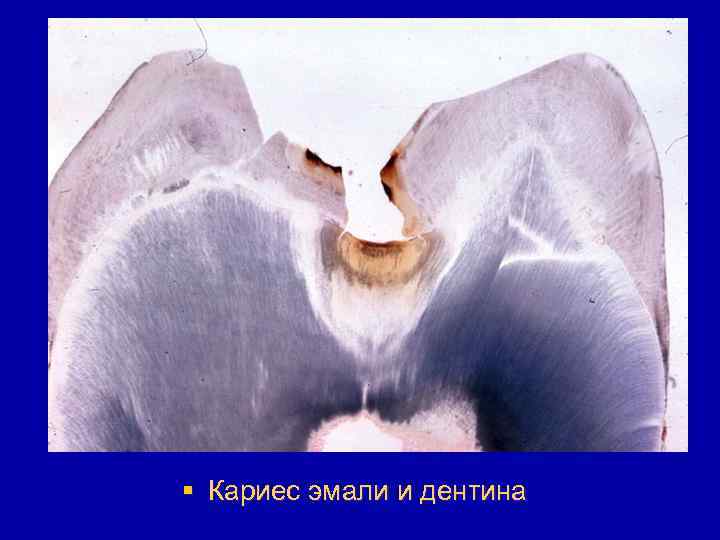 § Кариес эмали и дентина 