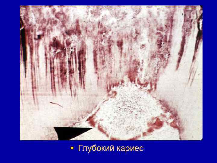 § Глубокий кариес 