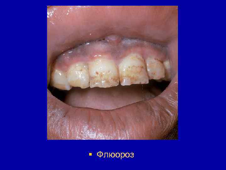 § Флюороз 