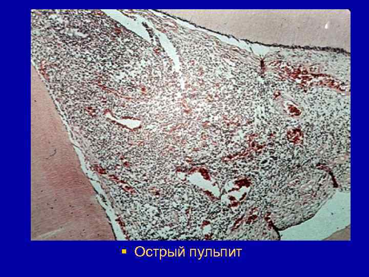 § Острый пульпит 