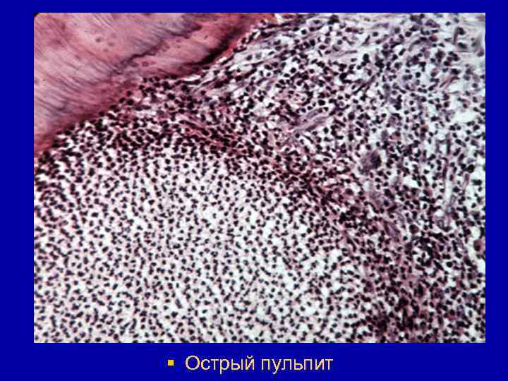 § Острый пульпит 