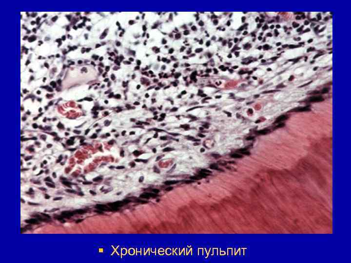§ Хронический пульпит 
