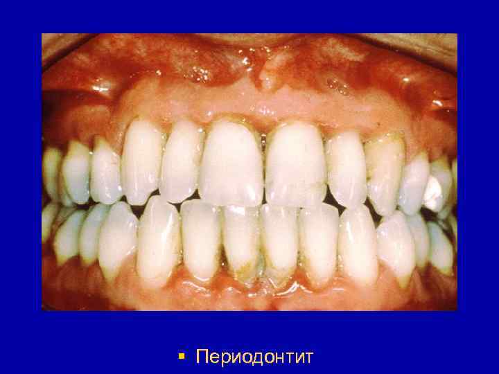 § Периодонтит 