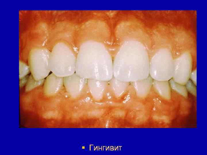 § Гингивит 