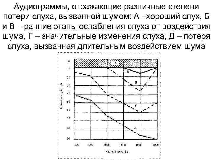 Аудиограммы, отражающие различные степени потери слуха, вызванной шумом: А –хороший слух, Б и В