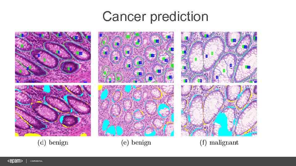 Cancer prediction CONFIDENTIAL 