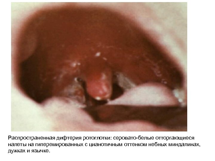 Распространенная дифтерия ротоглотки: серовато-белые отторгающиеся налеты на гиперемированных с цианотичным оттенком небных миндалинах, дужках