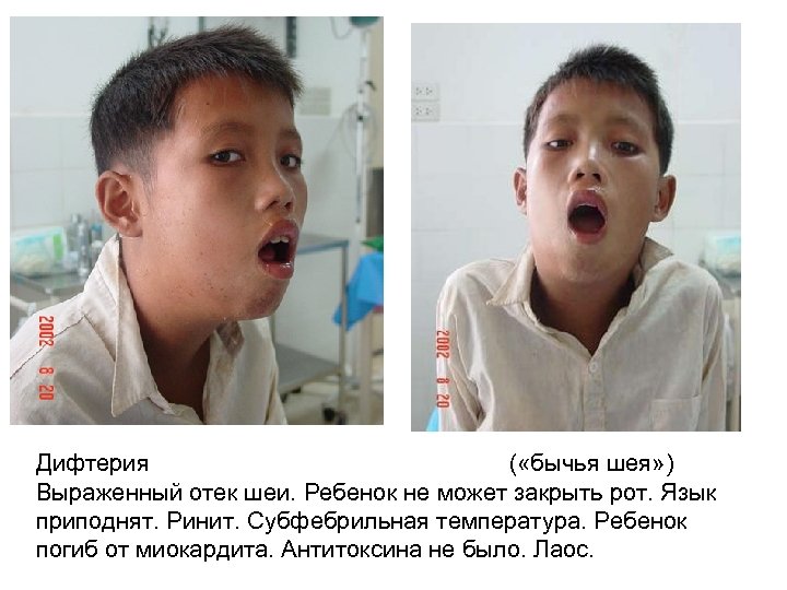 Дифтерия ( «бычья шея» ) Выраженный отек шеи. Ребенок не может закрыть рот. Язык