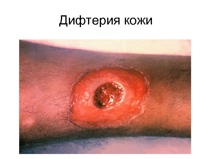 Дифтерия кожи 