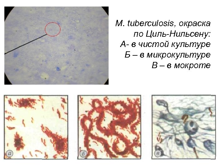 М. tuberculosis, окраска по Циль-Нильсену: А- в чистой культуре Б – в микрокультуре В