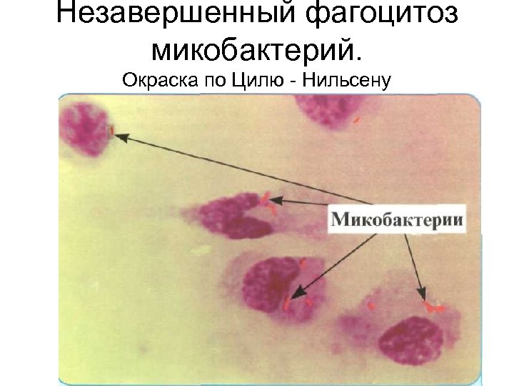 Незавершенный фагоцитоз микобактерий. Окраска по Цилю - Нильсену 