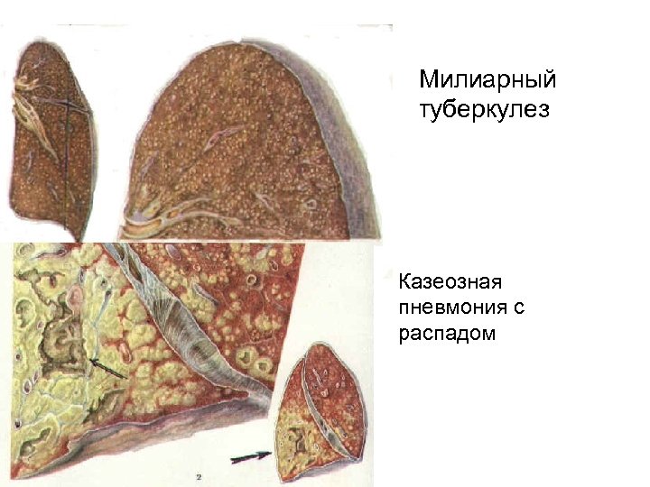 Милиарный туберкулез Казеозная пневмония с распадом 
