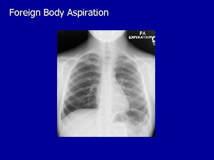 Foreign Body Aspiration 