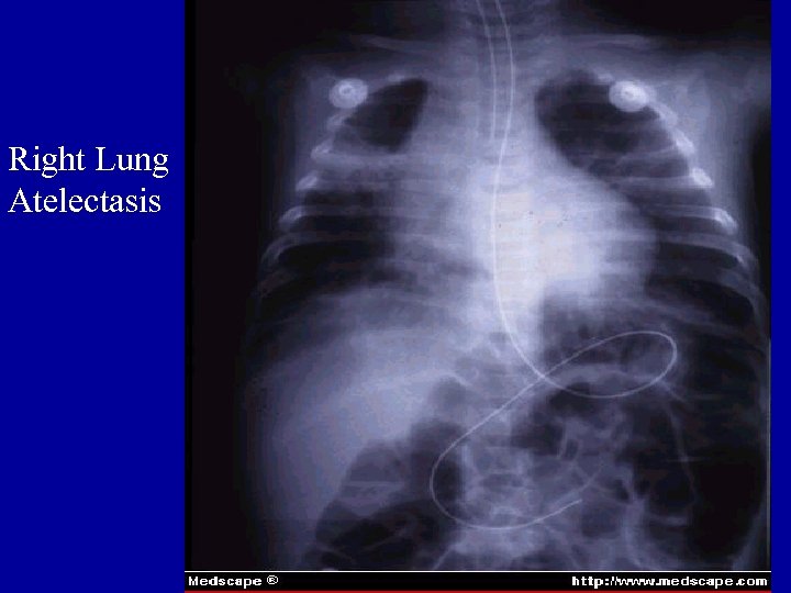 Right Lung Atelectasis 